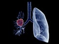 A lung tumor Royalty Free Stock Photo