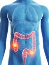 A mans colon cancer Royalty Free Stock Photo