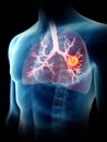 A mans lung tumor Royalty Free Stock Photo