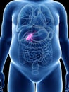 An obese mans gallbladder