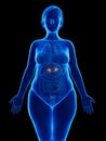 An obese womans adrenal glands Royalty Free Stock Photo