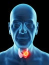 An old mans thyroid gland cancer