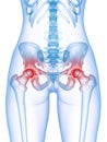 a painful hip joint