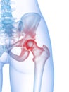 A painful hip joint