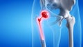 a painful hip replacement