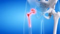 a painful hip replacement