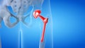 a painful hip replacement