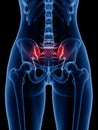 A painful sacroiliac joint