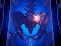 A painful sacroiliac joint