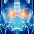 A painful sacrum joint