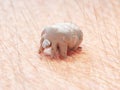 a scabies mite Royalty Free Stock Photo