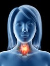 Thyroid cancer Royalty Free Stock Photo