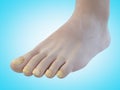 Toe nail fungus