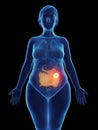 A tumor in a womans small intestine