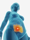 a tumor in a womans small intestine