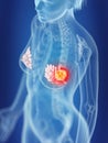 A womans mammary glands cancer Royalty Free Stock Photo