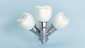 3D rendering of dental implant structure, medical teeth implant, design of dentistry, implant screw, healthcare, dentist and