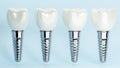 3D rendering of dental implant structure, medical teeth implant, design of dentistry, implant screw, healthcare, dentist and