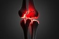 3d rendering of a fractured human knee joint with glowing red pain bone broken Royalty Free Stock Photo