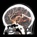 3D Rendering image of the human brain showing normal arteries in the head by CT SCANNER.