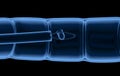 X-ray polyp removal Royalty Free Stock Photo