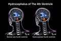 Enlargement of the fourth brain ventricle, 3D illustration