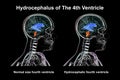 Enlargement of the fourth brain ventricle, 3D illustration