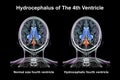 Enlargement of the fourth brain ventricle, 3D illustration