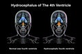 Enlargement of the fourth brain ventricle, 3D illustration