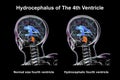 Enlargement of the fourth brain ventricle, 3D illustration