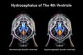 Enlargement of the fourth brain ventricle, 3D illustration