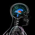 Enlargement of the third brain ventricle, 3D illustration