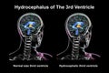 Enlargement of the third brain ventricle, 3D illustration