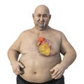 A 3D scientific illustration of an obese man with transparent skin revealing an ascending aortic aneurysm