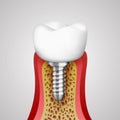 3d teeth in a cut with nerve endings. Royalty Free Stock Photo