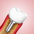 3d teeth in a cut with nerve endings. Royalty Free Stock Photo
