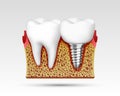 3d teeth in a cut with nerve endings. Royalty Free Stock Photo