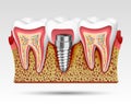 3d teeth in a cut with nerve endings Royalty Free Stock Photo