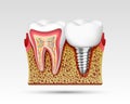 3d teeth in a cut with nerve endings Royalty Free Stock Photo