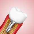 3d teeth in a cut with nerve endings Royalty Free Stock Photo