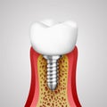 3d teeth in a cut with nerve endings Royalty Free Stock Photo