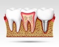 3d teeth in a cut with nerve endings. Royalty Free Stock Photo