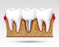 3d teeth in a cut with nerve endings. Royalty Free Stock Photo