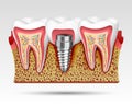 3d teeth in a cut with nerve endings. Royalty Free Stock Photo