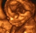 3D Ultrasonography Analysis of a 4th Month Fetus