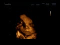 3D ultrasonography