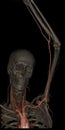 3D upper limb ct angiography