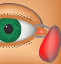 Dacryocyst. Inflammation of the lacrimal sac of the eye. The structure of the eye. Infographics. Vector illustration