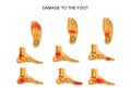 Damage to the foot