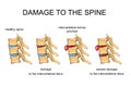 DAMAGE TO THE SPINE Royalty Free Stock Photo